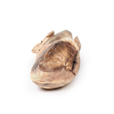 Stenoză pulmonară congenitală