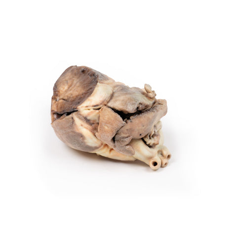 Stenoză pulmonară congenitală