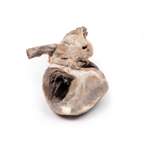 Tetralogia Fallot