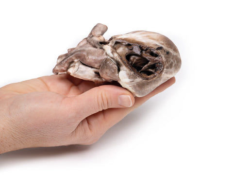 Tetralogia Fallot