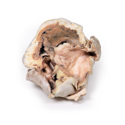 Stenoză valvulară aortică calcificată – valvă aortică bicuspidă