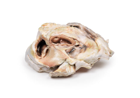 Stenoză valvulară aortică calcificată – valvă aortică bicuspidă