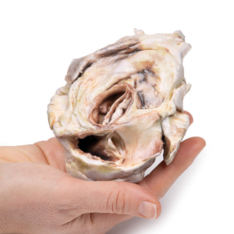Stenoză valvulară aortică calcificată – valvă aortică bicuspidă