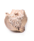 Endocardită bacteriană acută