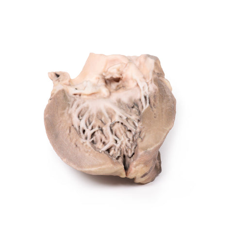 Endocardită bacteriană acută