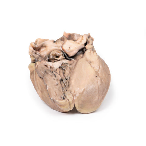 Endocardită bacteriană acută