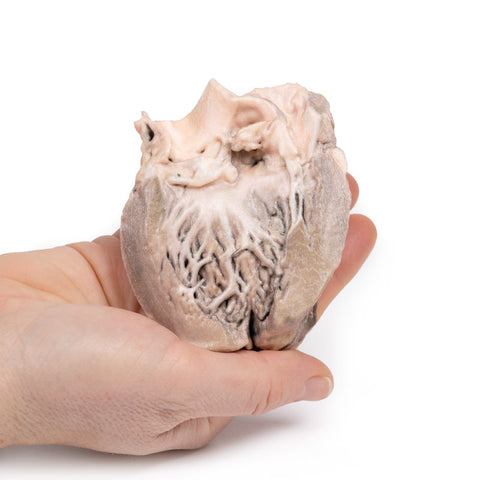 Endocardită bacteriană acută
