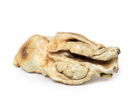 Carcinom laringian