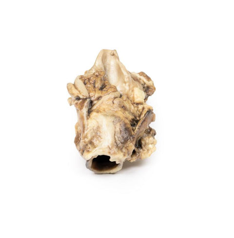 Carcinom al sinusului piriform