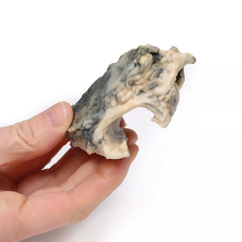 Carcinom laringian