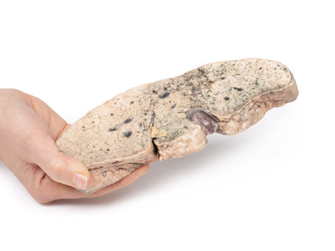 Ciroză hepatică