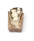 Colelitiază (calculi biliari)