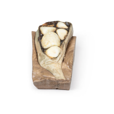 Colelitiază (calculi biliari)