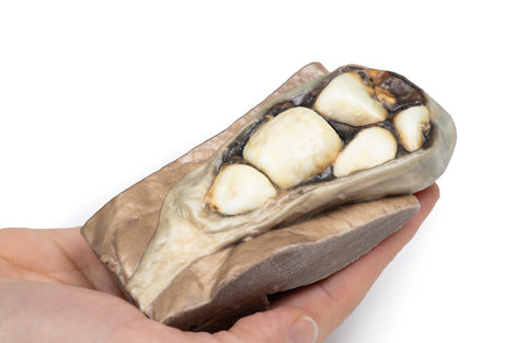 Colelitiază (calculi biliari)