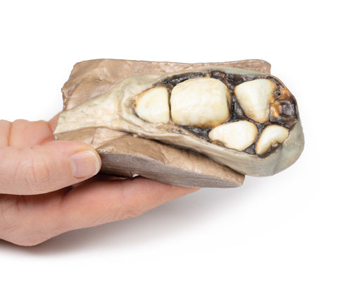 Colelitiază (calculi biliari)