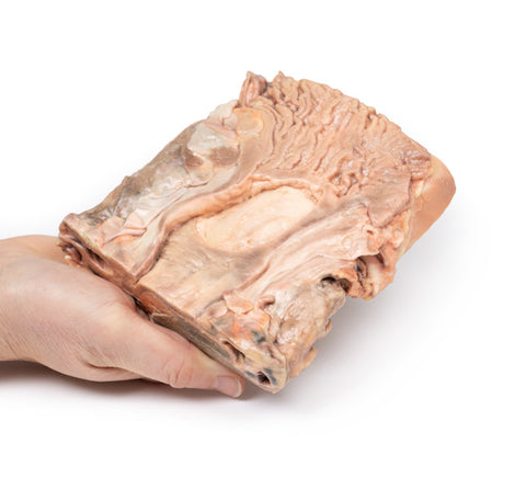 Ulcer gastric cronic
