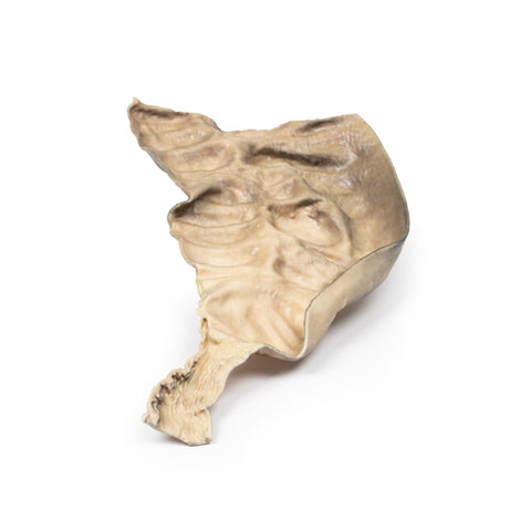 Boala Hirschsprung