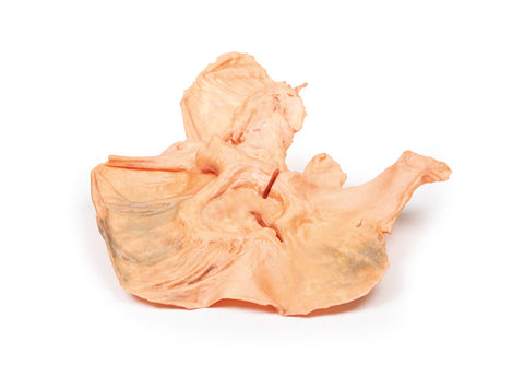 Adenocarcinom gastric