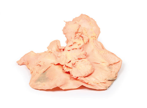Adenocarcinom gastric