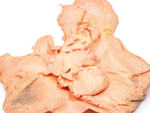 Adenocarcinom gastric