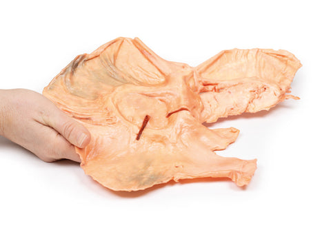 Adenocarcinom gastric