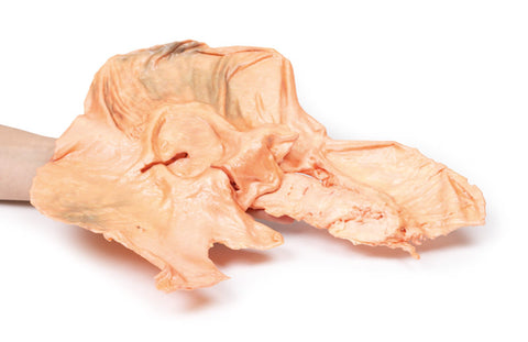 Adenocarcinom gastric