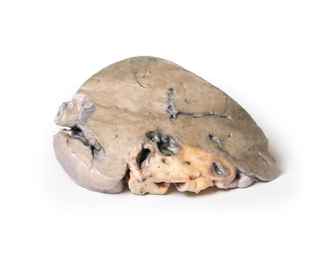 Calculi ai canalului hepatic și ciroză biliară obstructivă
