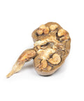 Calculi renali multipli