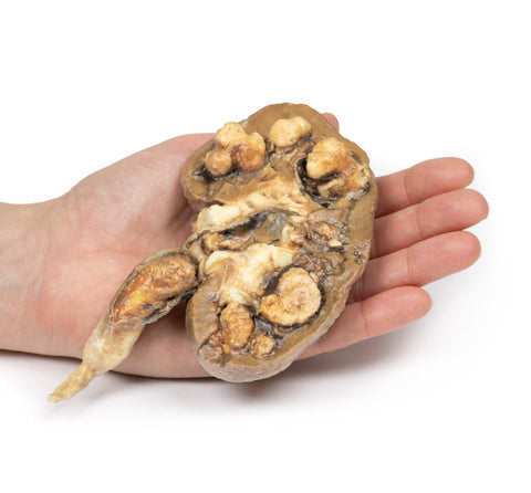Calculi renali multipli