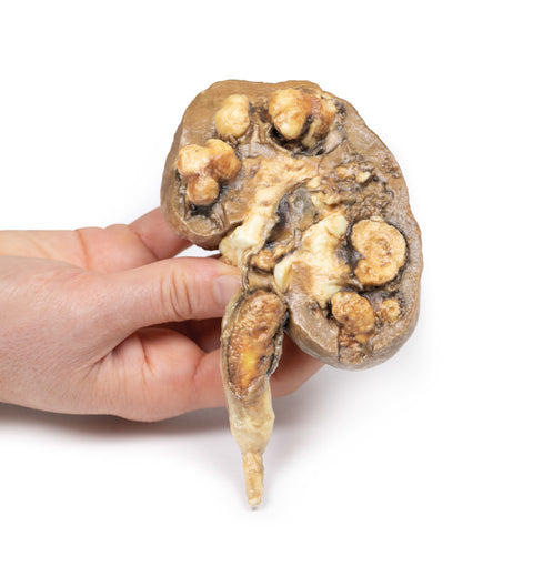 Calculi renali multipli