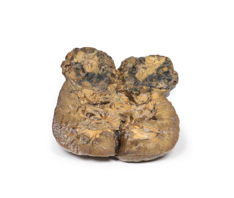 Carcinom renal cu celule clare