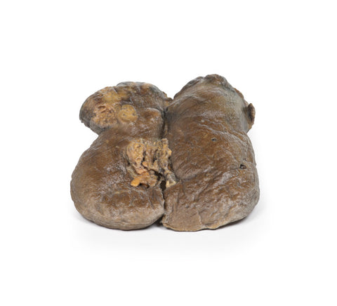 Carcinom renal cu celule clare