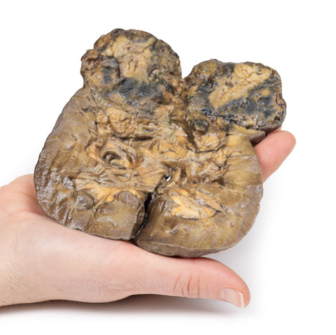 Carcinom renal cu celule clare