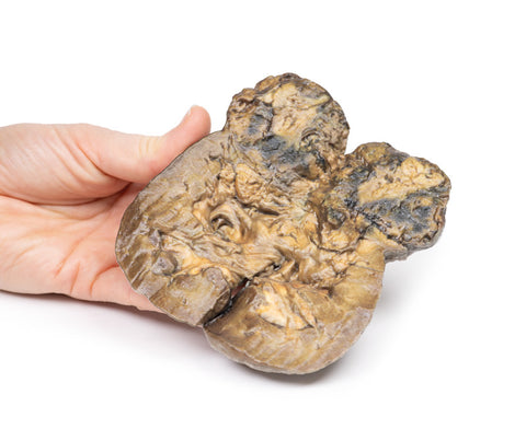 Carcinom renal cu celule clare