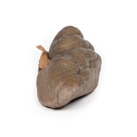 Carcinom papilar cu celule tranziționale al pelvisului renal