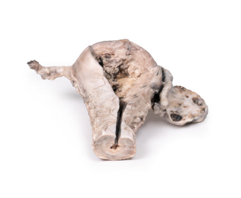 Carcinom endometrial