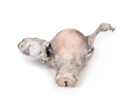 Carcinom endometrial