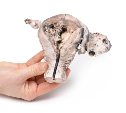 Carcinom endometrial