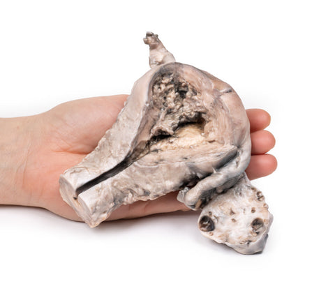 Carcinom endometrial
