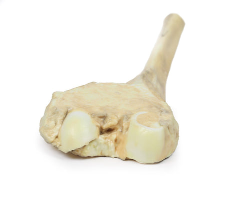 Osteosarcom al femurului