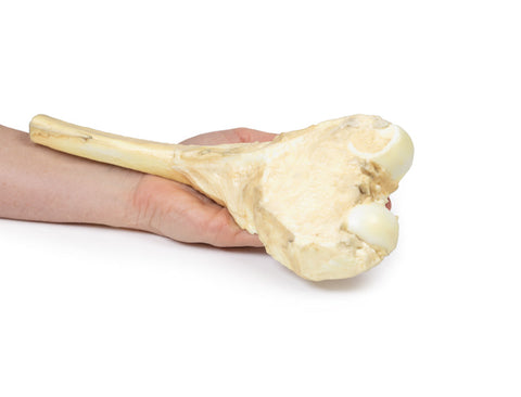 Osteosarcom al femurului