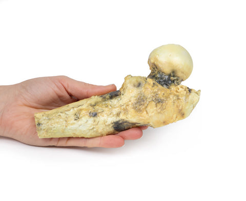 Osteosarcom femural