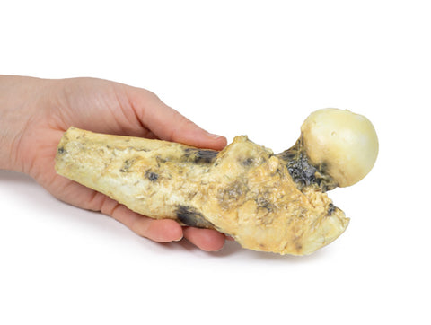 Osteosarcom femural