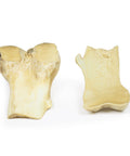 Osteocondrom