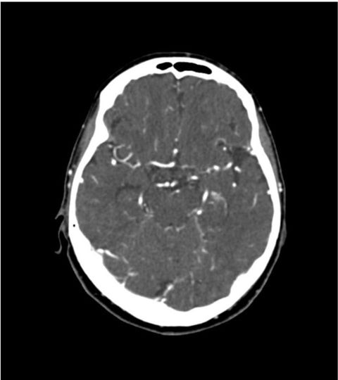 Fantomă cap pentru angiografie CT