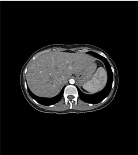 Fantomă abdominală pentru CT, radiografie și radioterapie