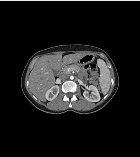 Fantomă abdominală pentru CT, radiografie și radioterapie