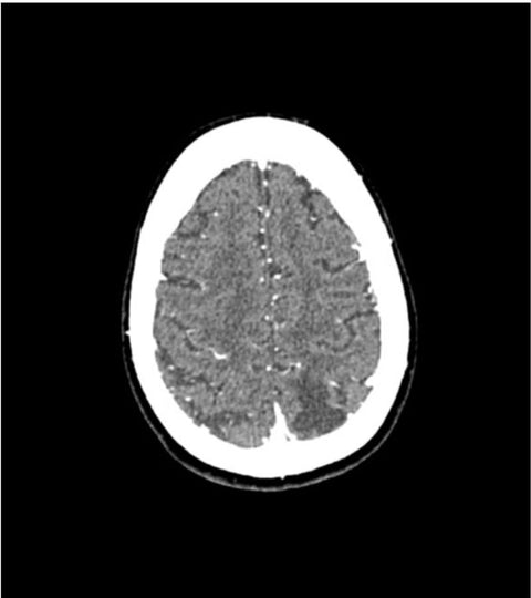 Fantomă cap „Anevrism” pentru CT, radiografie și radioterapie