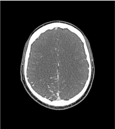 Fantomă cap „AVM” pentru CT, radiografie și radioterapie