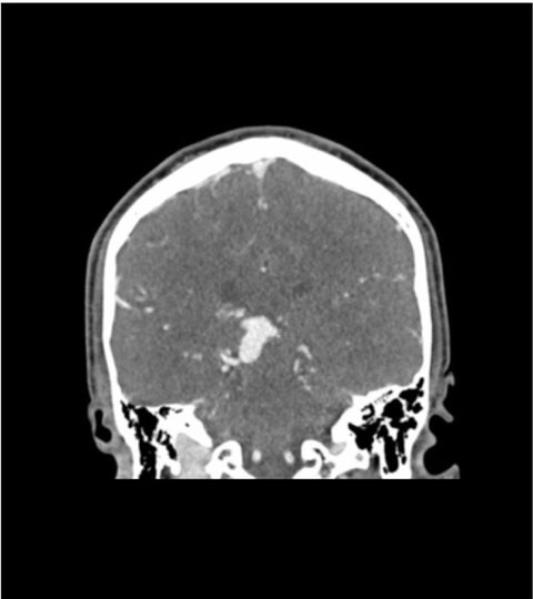 Fantomă cap „AVM” pentru CT, radiografie și radioterapie